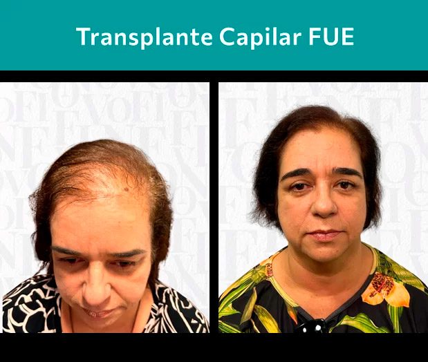 Resultado de implante capilar antes e depois técnica FUE em Ribeirão Preto