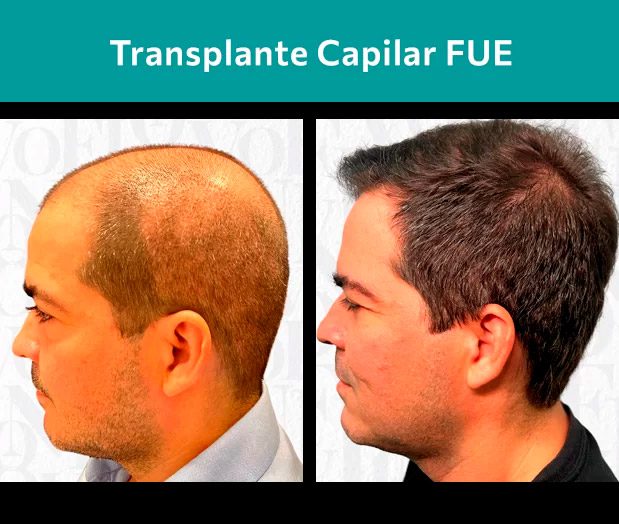 Resultado de implante capilar antes e depois técnica FUE em Ribeirão Preto