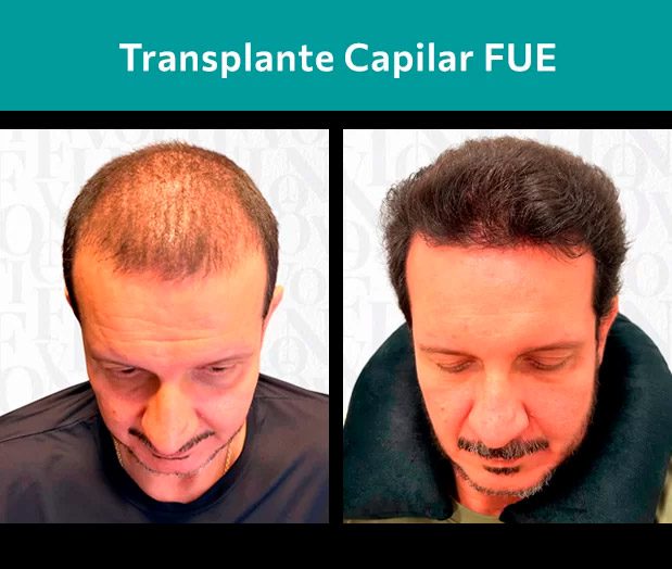 Resultado de implante capilar antes e depois técnica FUE em Ribeirão Preto