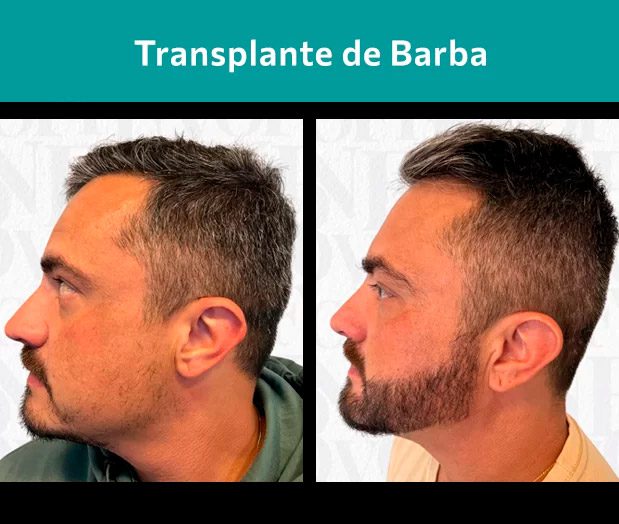 Resultado de implante capilar antes e depois técnica FUE em Ribeirão Preto