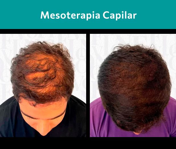 Resultado de implante capilar antes e depois técnica FUE em Ribeirão Preto